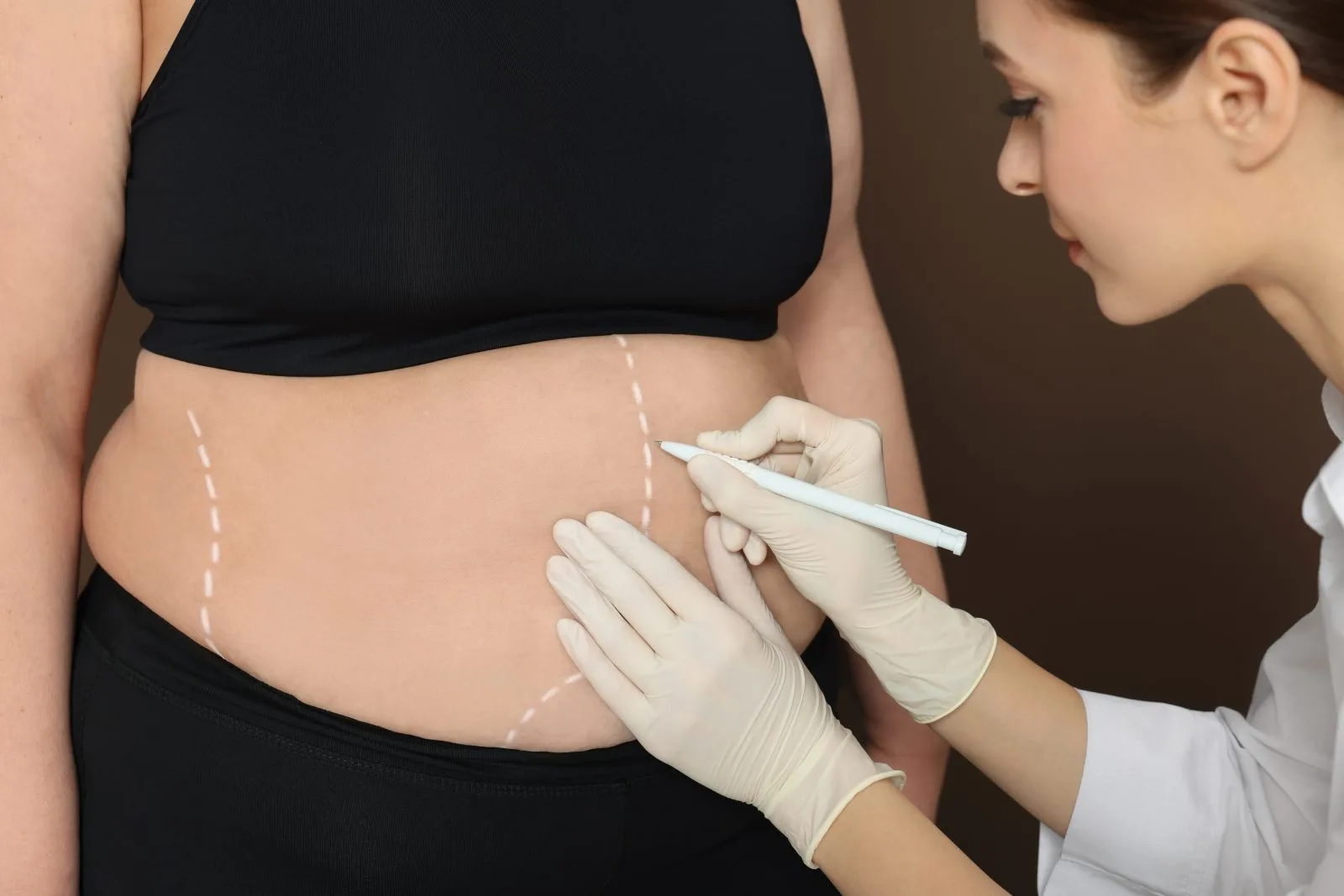 Provider marking a patient's abdomen to plan body contouring treatment